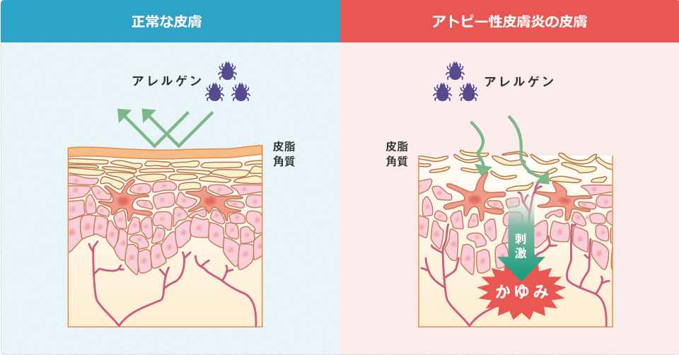 正常な皮膚とアトピー性皮膚炎の皮膚の比較